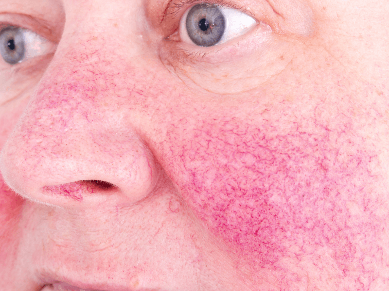 Một số hình ảnh về bệnh rosacea