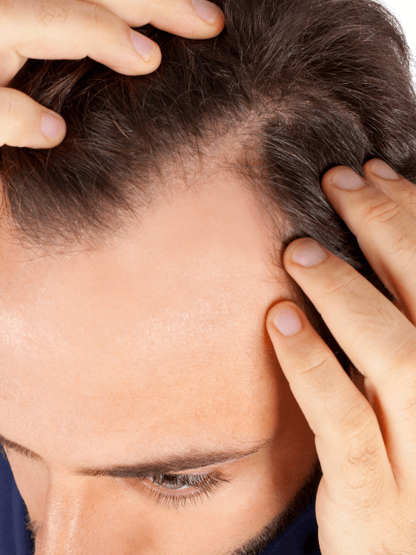 Rụng tóc Agenda thường xuất hiện ở nang giới do quy luật di truyền